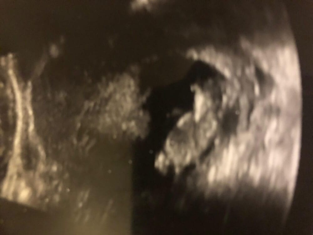 Ultrasound